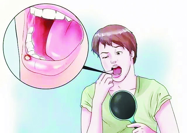 口腔潰瘍不是只需要補(bǔ)充維生素C，它們也是必不可少